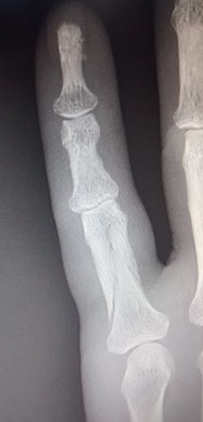 x-ray of my broken finger