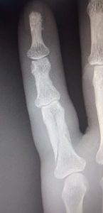 x-ray of broken finger